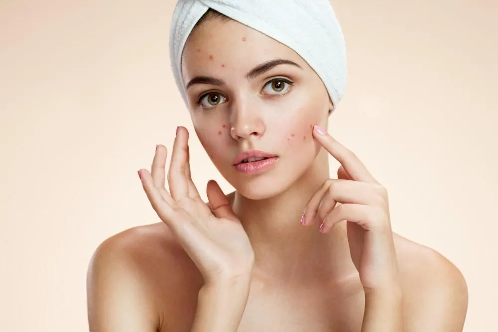 A teenager with a towel wrapped around her hair touches acne spots on her cheek.